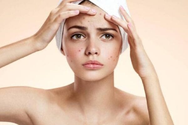 Empat Kebiasaan Salah dalam Mengobati Jerawat